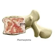 Plasmacytoma.jpg
