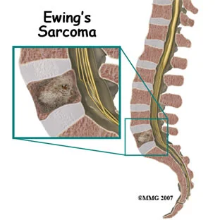 spinal_tumor_ewings.jpg