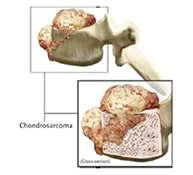 Chondrosarcoma.jpg