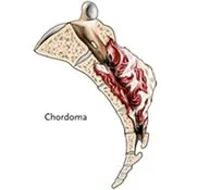 Chordoma.jpg