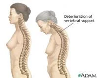 osteoporosis_clip_image008.jpg