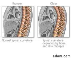 osteoporosis_clip_image010.jpg