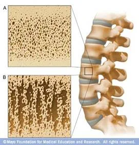 osteoporosis_clip_image012.jpg