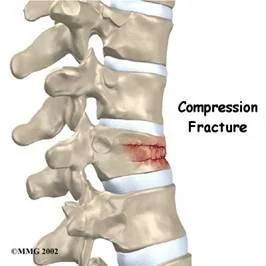 osteoporosis_clip_image014.jpg
