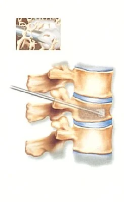 osteoporosis_clip_image017.jpg