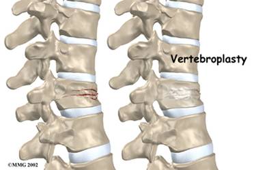 osteoporosis_clip_image019.jpg