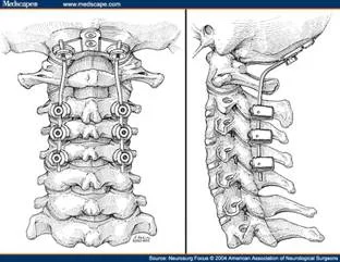 neck_pain_inflammatory_clip_image012.jpg