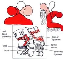 neck_pain_trauma_clip_image002.jpg