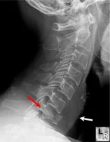 neck_pain_trauma_clip_image017.jpg