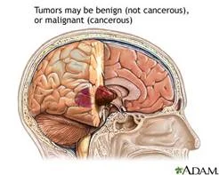 brain_tumours_clip_image002.jpg
