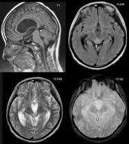 brain_tumours_clip_image002_0000.jpg