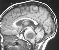 brain_tumours_clip_image004_0000.jpg