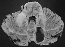 brain_tumours_clip_image006.jpg