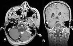 brain_tumours_clip_image008.jpg