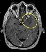 brain_tumours_clip_image012.jpg