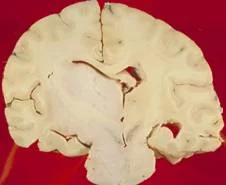 brain_tumours_clip_image010.jpg
