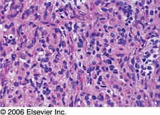 brain_tumours_clip_image013.jpg