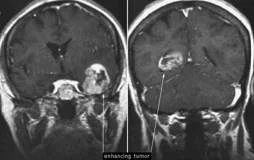 brain_tumours_clip_image017.jpg