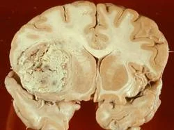 brain_tumours_clip_image019.jpg
