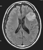 brain_tumours_clip_image021.jpg