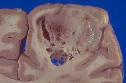 brain_tumours_clip_image023.jpg