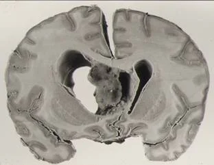 brain_tumours_clip_image027.jpg