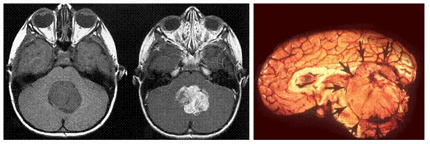 Medulloblastoma.jpg