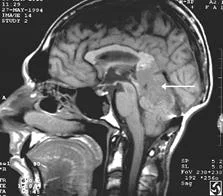 brain_tumours_clip_image034.jpg