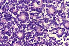 brain_tumours_clip_image032.jpg