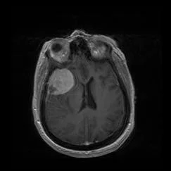 brain_tumours_clip_image036.jpg