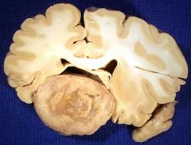 brain_tumours_clip_image038.jpg
