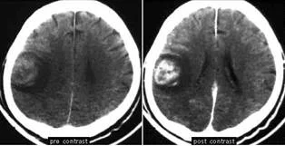 brain_tumours_clip_image004_0001.jpg