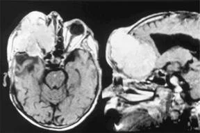 brain_tumours_clip_image002_0001.jpg