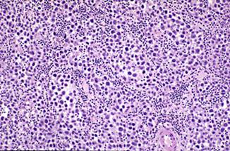 brain_tumours_clip_image006_0000.jpg