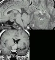 brain_tumours_clip_image008_0000.jpg