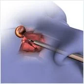 pituitary_surgery_clip_image005.jpg