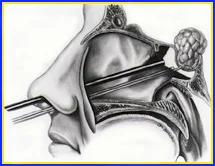pituitary_surgery_clip_image006.jpg