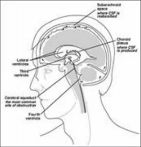 hydrocephalus_clip_image003.jpg
