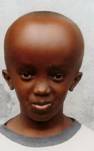 hydrocephalus_clip_image005.jpg