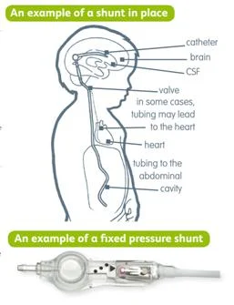 hydrocephalus_clip_image009.jpg