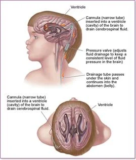 hydrocephalus_clip_image007.jpg