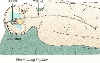 hydrocephalus_clip_image010.jpg