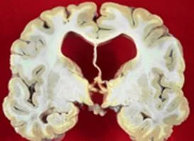 hydrocephalus_clip_image020.jpg