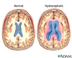 hydrocephalus_clip_image018.jpg