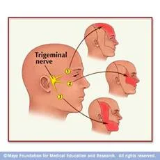 trigeminal_Neuralgia_clip_image002.jpg