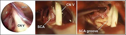 trigeminal_Neuralgia_clip_image007.jpg