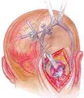 trigeminal_Neuralgia_clip_image013.jpg