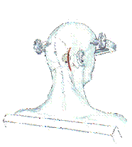 trigeminal_Neuralgia_clip_image011.gif