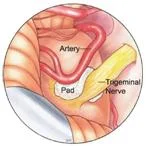 trigeminal_Neuralgia_clip_image015.jpg