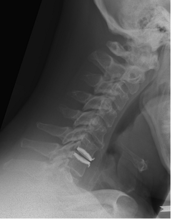 Artificial_Discs_clip_image004.gif